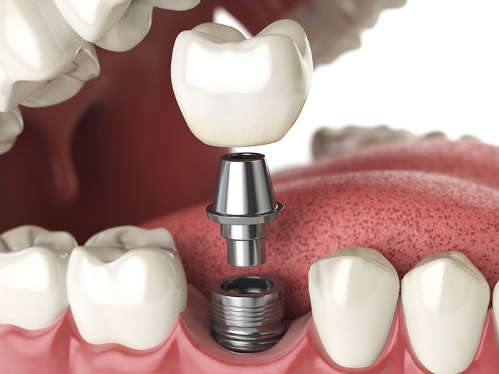 Имплантология - новое направление в зубном деле